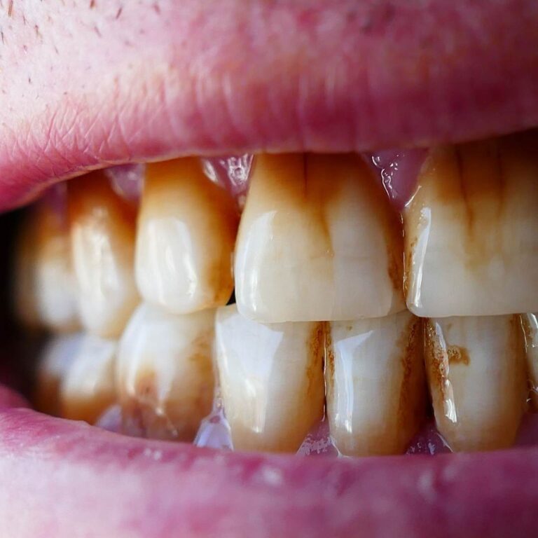 Why are my teeth staining